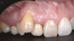 blog - dr brice riera - endodontie - traces dincisions