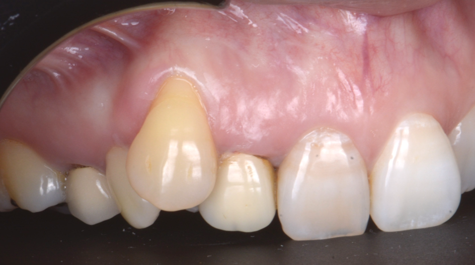 blog - dr brice riera - endodontie - traces dincisions