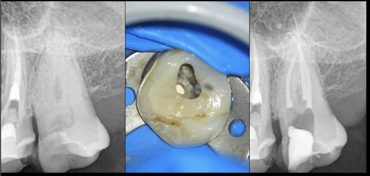 BLOG - Dr Brice Riera - Endodontie - Petite ouverture bucale