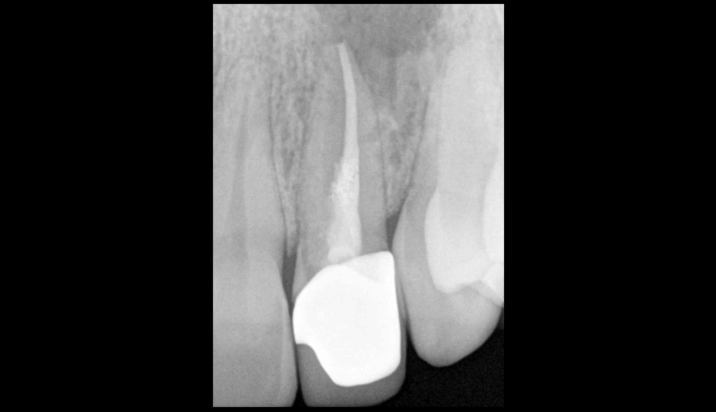 BLOG - Dr Brice Riera - Endodontie - le facteur le plus important