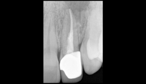 BLOG - Dr Brice Riera - Endodontie - le facteur le plus important