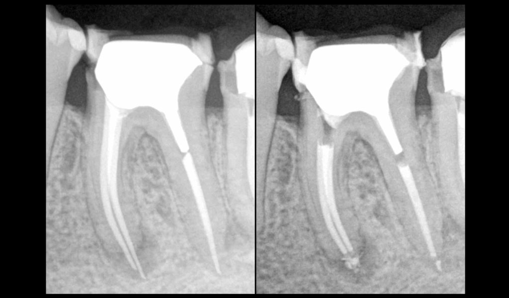 BLOG - Dr Brice Riera - Endodontie - protocole pour desobturer