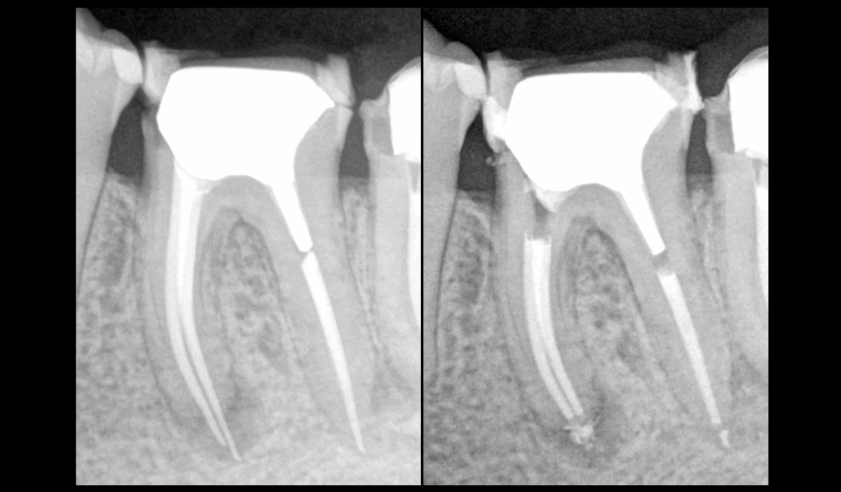 BLOG - Dr Brice Riera - Endodontie - protocole pour desobturer