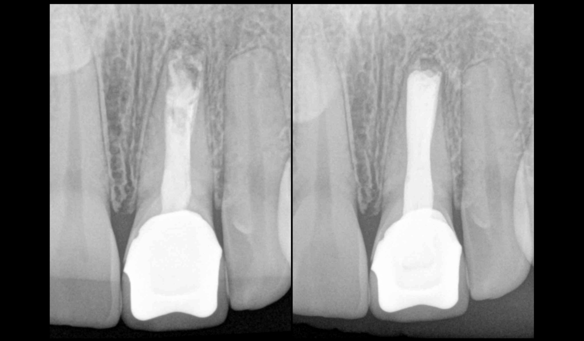 BLOG - Dr Brice Riera - Endodontie - technique obturation