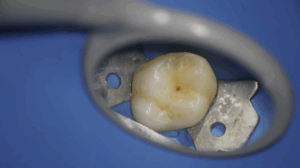 BLOG - Dr Brice Riera - Endodontie - technique pose de digue
