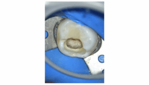 BLOG - Dr Brice Riera - Prevalence pose de digue - endodontie