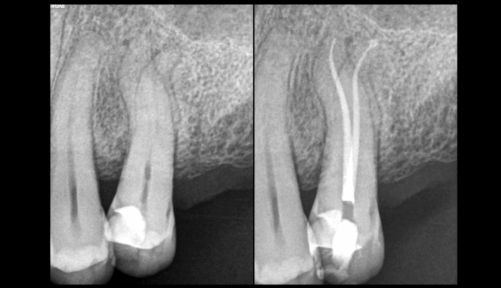 BLOG - Dr brice Riera - endodontie - courbures legeres