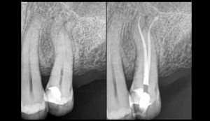 BLOG - Dr brice Riera - endodontie - courbures legeres