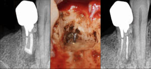 BLOG - dr brice riera - endodontie - instruments fractures