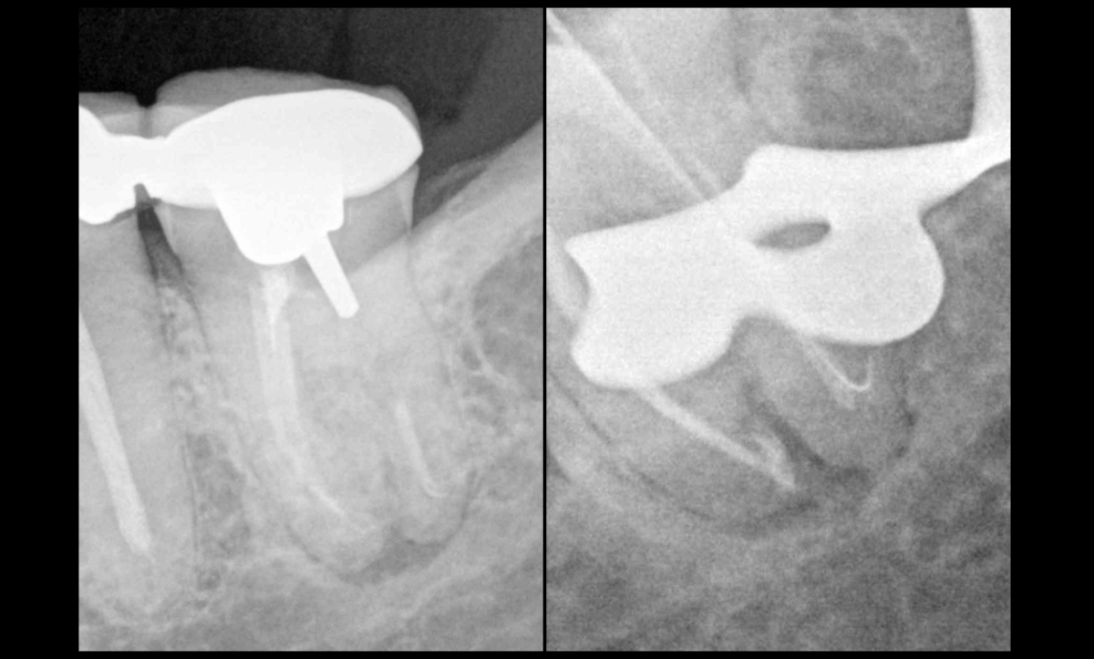 BLOG - Dr Brice Riera - Endodontie - courbures et limes manuelles