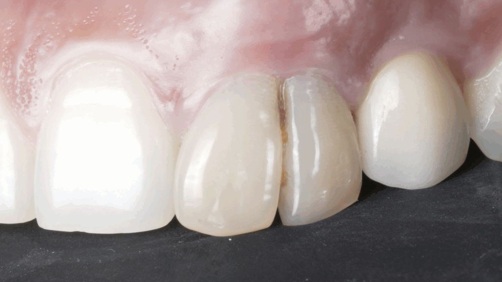 gemination - dr brice riera - endodontie - blog