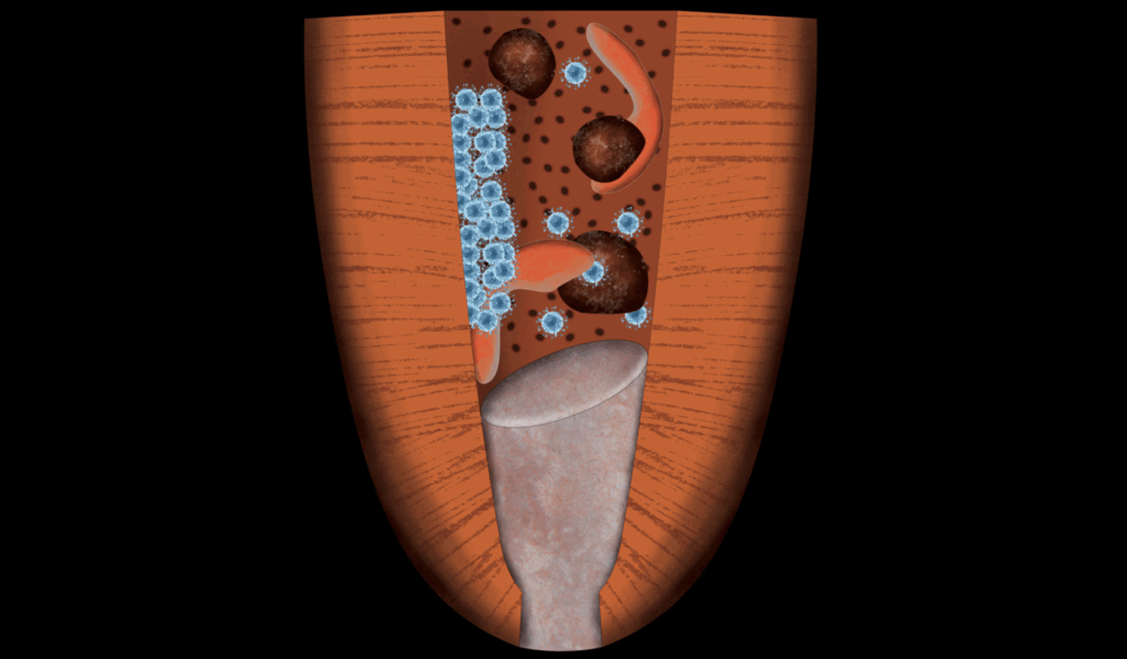 BLOG - Dr Brice RIera- Endodontie - perte efficacite hypochlorite