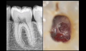BLOG - Dr Brice Riera - Cellules processus resorptif