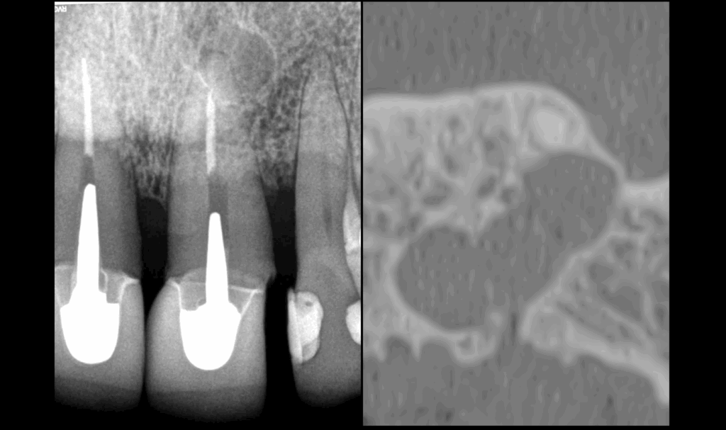 BLOG - Dr Brice Riera - Endodontie lésion apicale asymptomatique