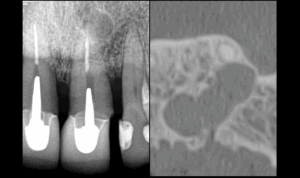 BLOG - Dr Brice Riera - Endodontie lésion apicale asymptomatique