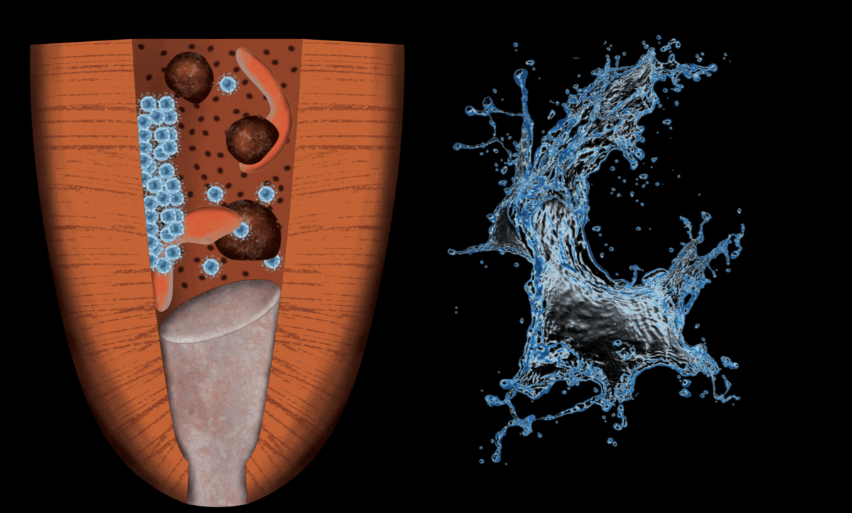 BLOG - Dr Brice Riera - Endodontie - solutions d irrigation en endodontie