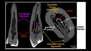 BLOG - Dr Brice Riera - resorption radiculaire - Endodontie