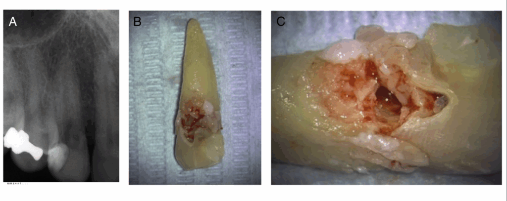 BLOG - Dr Brice Riera - résorption radiculaire cervicale externe de cette canine