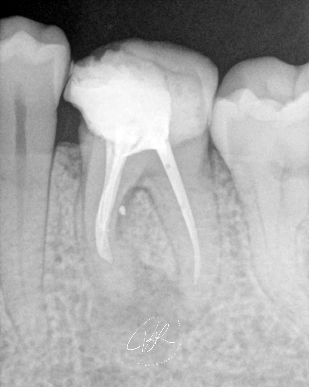 1 - Blog - Dr Brice Riera - anatomie interessante - endodontie