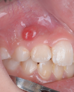 Blog - Dr Brice Riera - antecedent traumatisme dentaire
