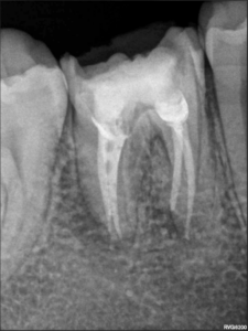 Cas Brice Riera Endodontiste