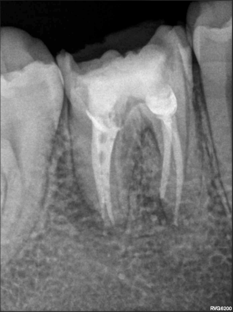 Cas Brice Riera Endodontiste