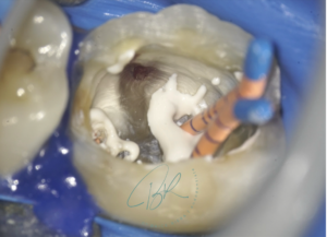 BLOG - Dr Brice Riera - Ciment endodontique