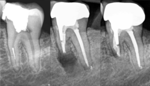 BLOG - Dr Brice Riera - decision therapeutique en endodontie