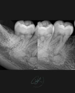 Cas - Cas de dysplasie cémento-osseuse sur 44 : diagnostic différentiel et signes cliniques présentés par le Dr Brice Riera.