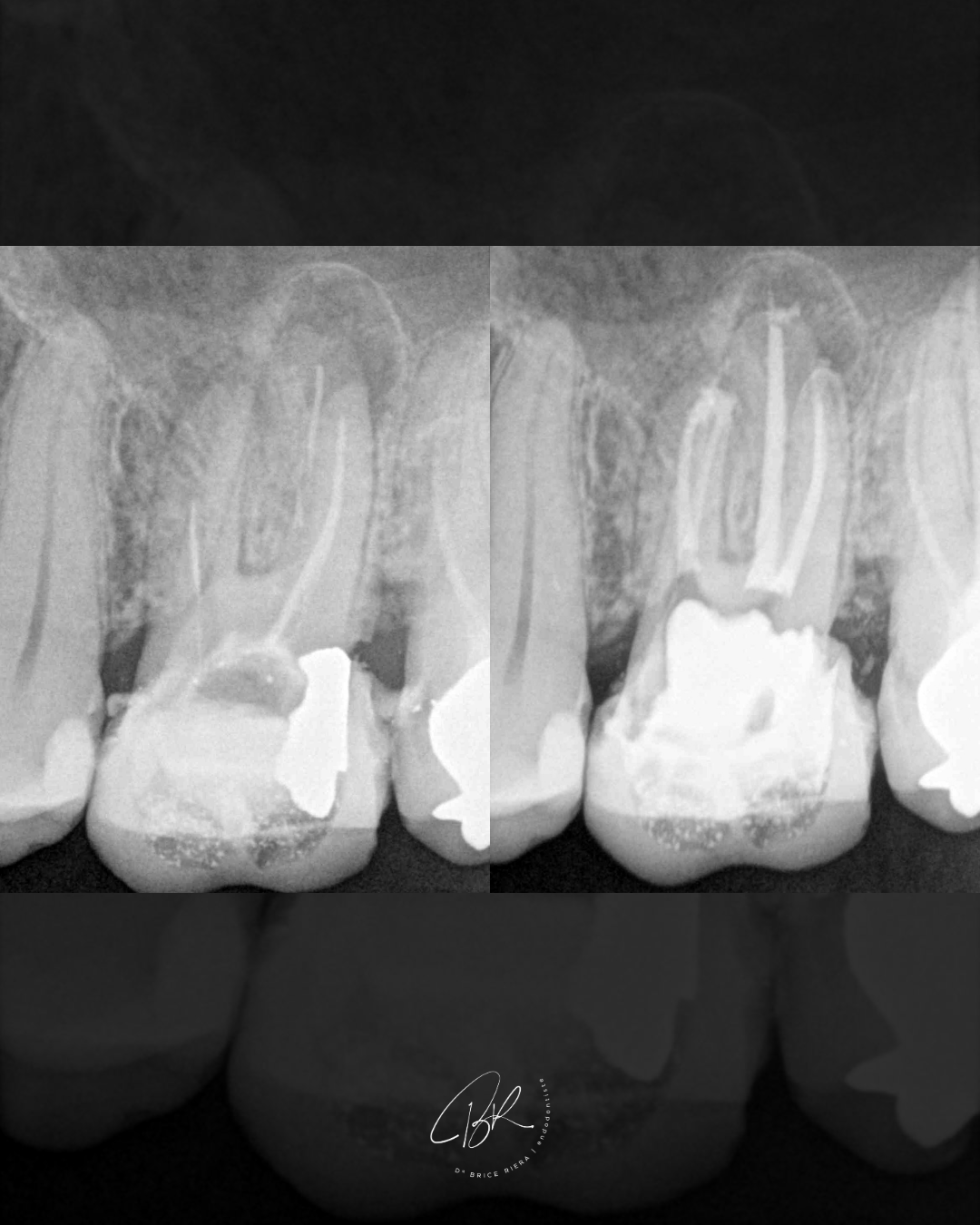 BLOG Dr Brice Riera - Différence de longueur de travail MV1 MV2