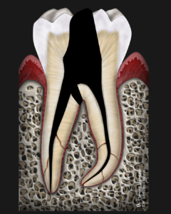 BLOG - Dr Brice Riera - facteurs perforation en endodontie