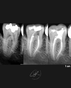 Pronostic sur dent felee - dr brice riera