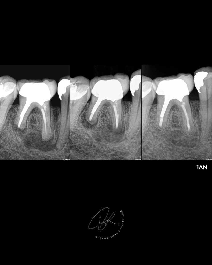 BLOG - DR Brice Riera - avantages micro chirurgie endodontique