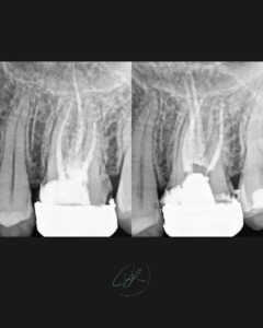 BLOG - Dr Brice RIera - Analyse canal palatin