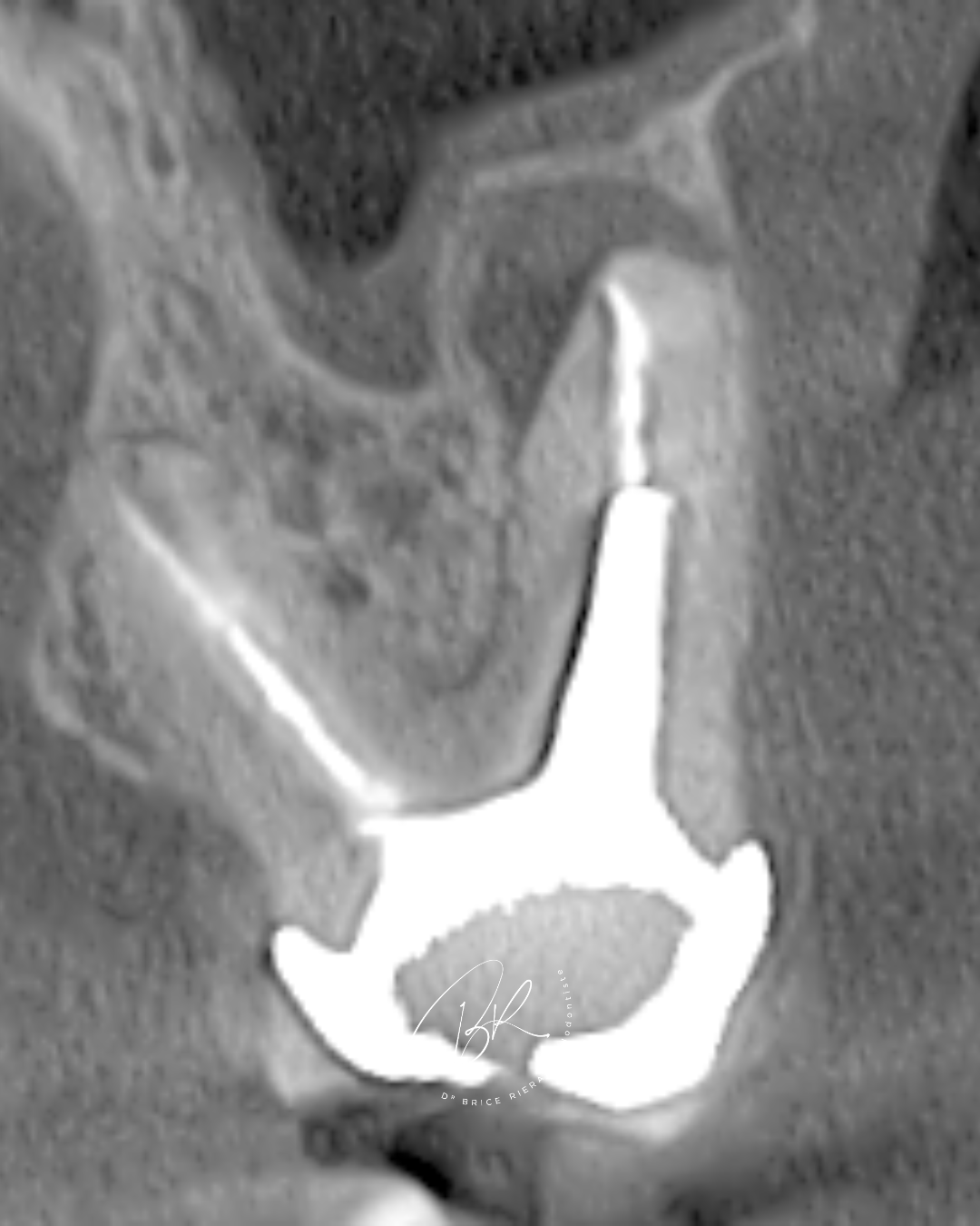 Blog - chirurgie endodontie - dr brice riera