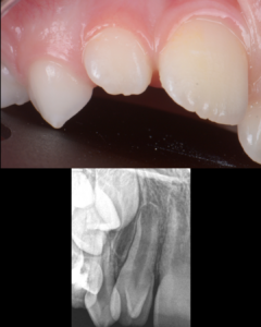 densevaginatus - blog edtm - endodontie