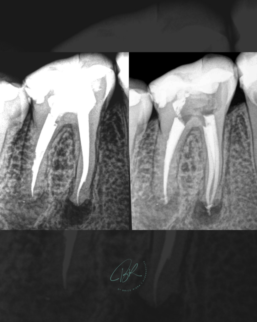 Blog EDTM - douleurs flare up - dr brice riera