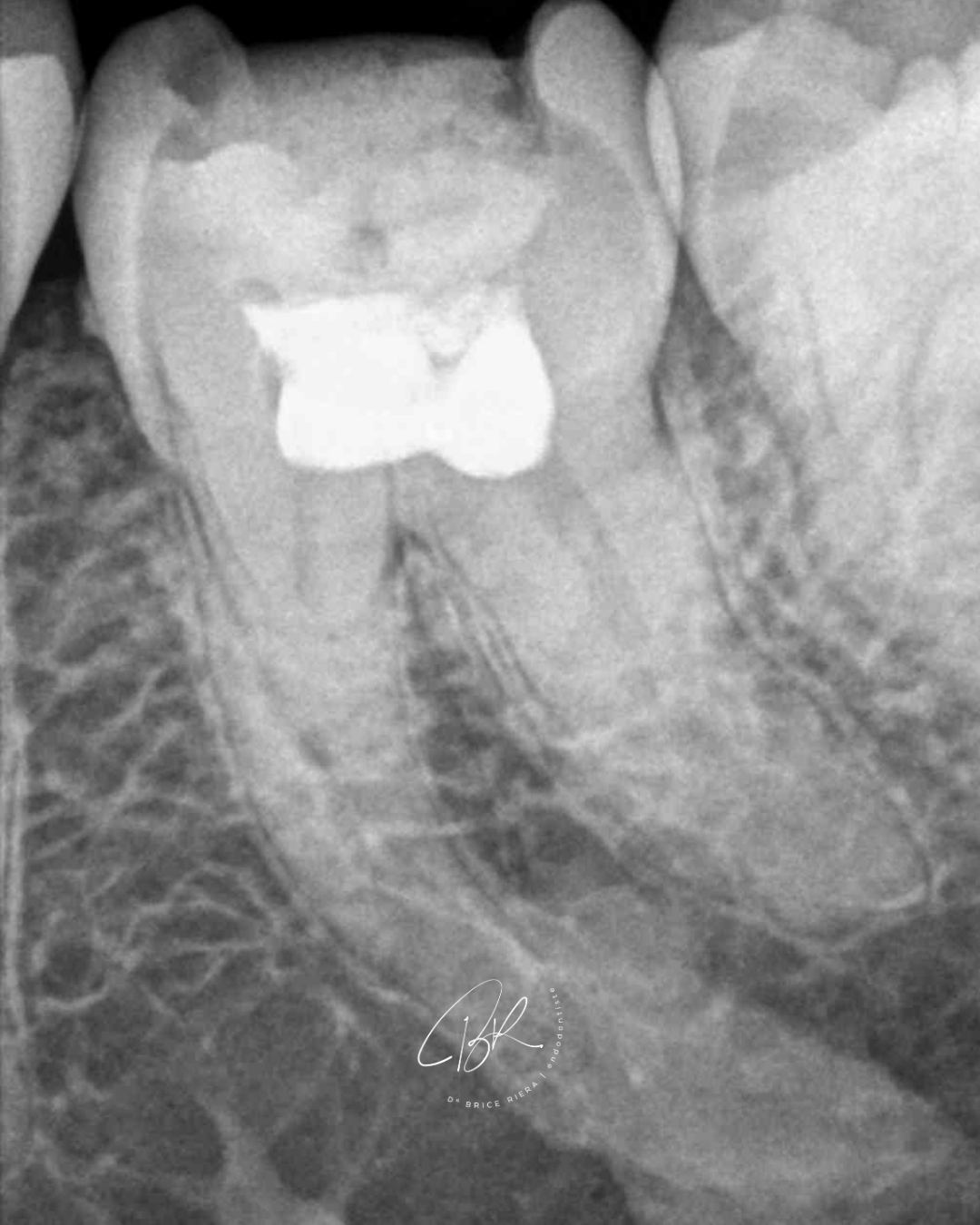 Cas EDTM - Dr Brice Riera - ostéite condensante
