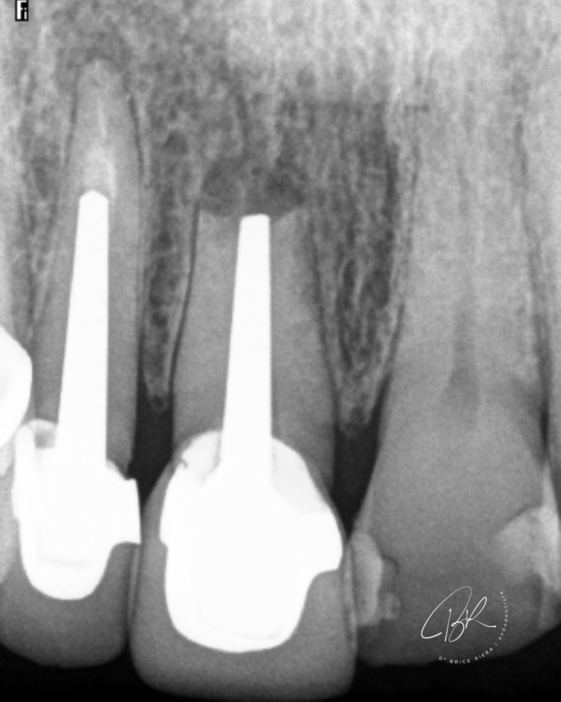Chirurgie endodontique -resection apicale - cas dr brice riera - endodontiste