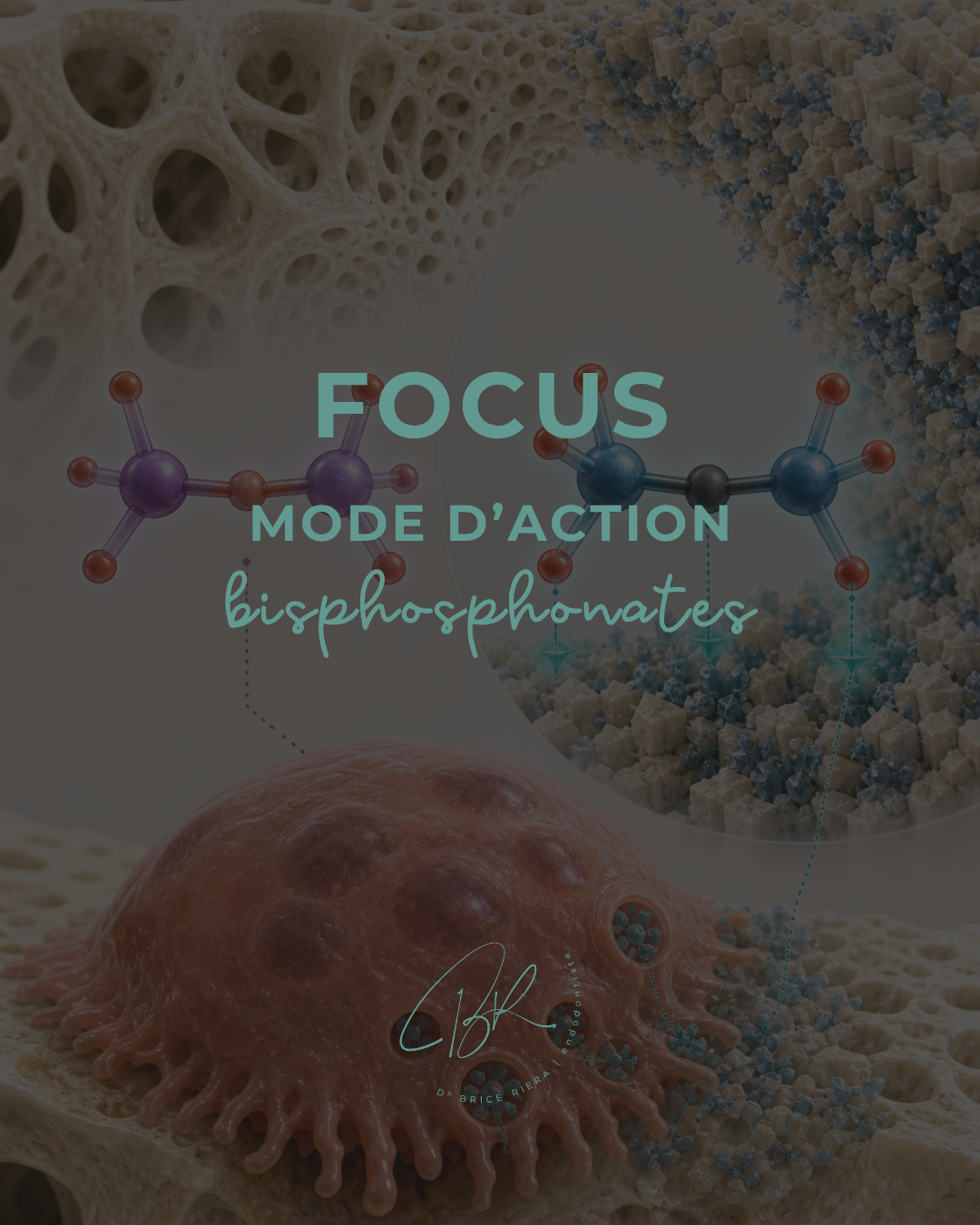 Les Bisphosphonates - EDTM - Dr Brice Riera Endodontie - Paris