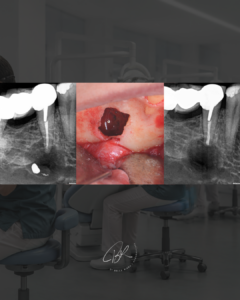 Troubles neurosensoriels après une chirurgie endodontique mandibulaire - dr brice riera