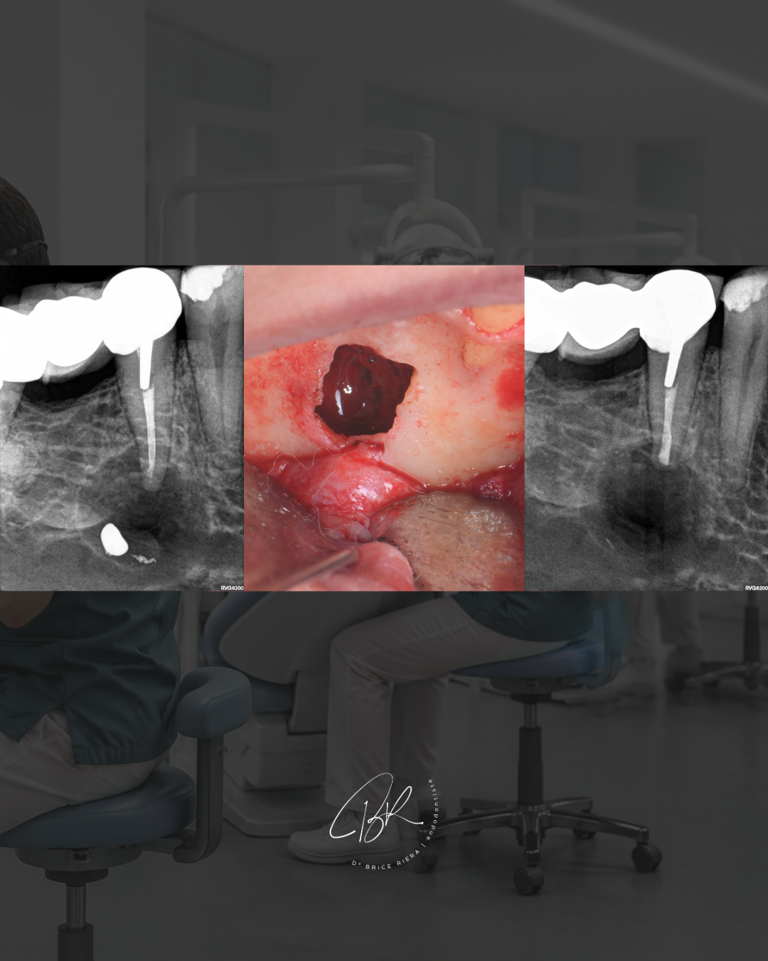 Troubles neurosensoriels après une chirurgie endodontique mandibulaire - dr brice riera