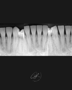 cas dysplasie cemento osseuse - edtm dr brice riera endodontie paris