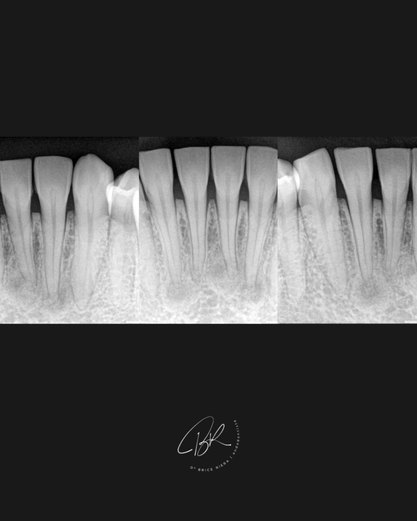 cas dysplasie cemento osseuse - edtm dr brice riera endodontie paris