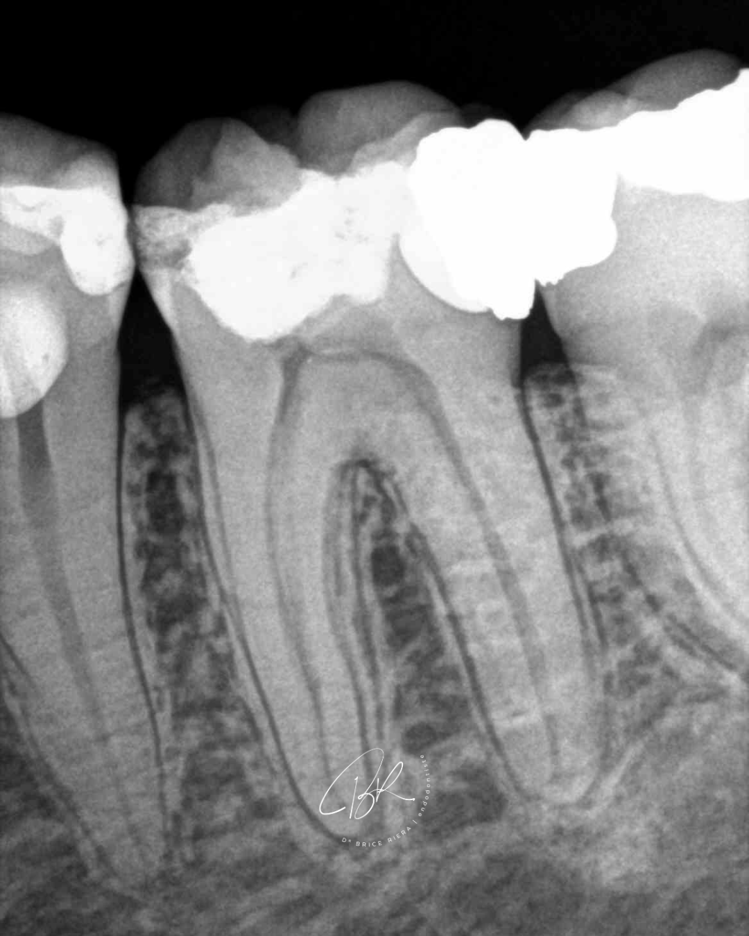 cas multiple microchirurgie endodontique